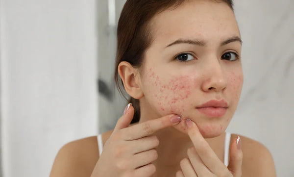 hydrating face mist for acne prone skin